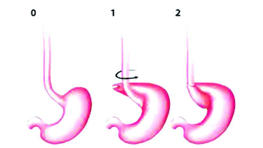 حرقة المعدة ترتبط بالارتجاع المريئي