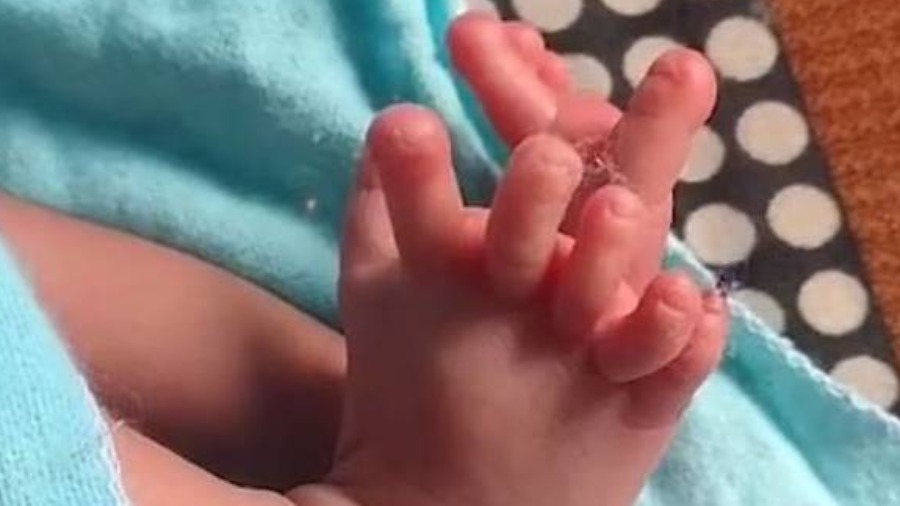 مولودة بـ 26 أصبعاً