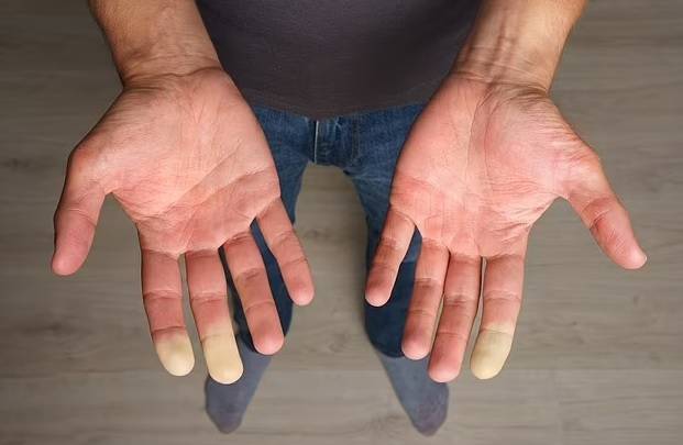 برودة الأطراف