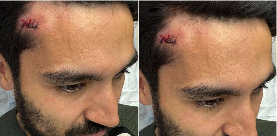  النجم الألماني بجرح في الرأس 