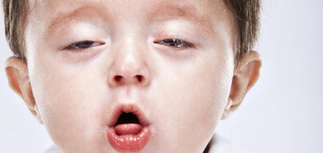 مرض ينقله الإنسان.. ما هو «السعال الديكي» شديد العدوى ويصيب الأطفال؟