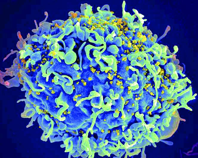 خلية مصابة بالإيدز
