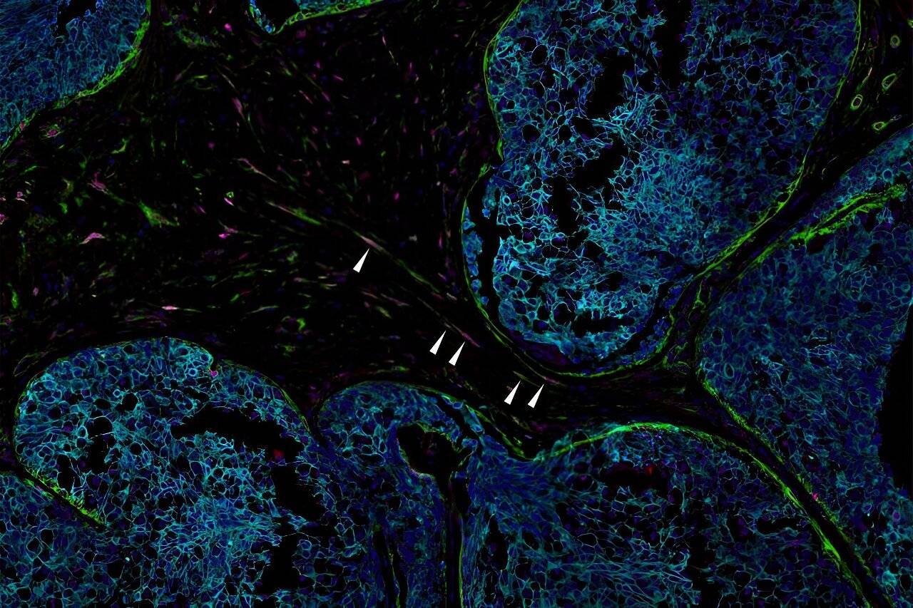  الأسهم البيضاء تشير إلى الخلايا الهرمة في ورم سرطاني
