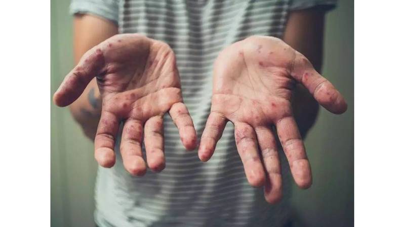 أول إصابة بـ«جدري القرود» في ألمانيا