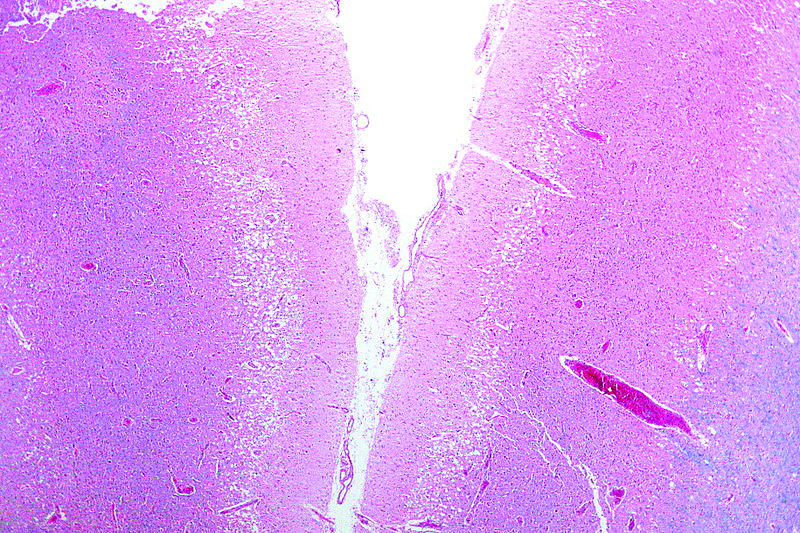 صورة مجهرية باللون الأبيض تظهر سكتة دماغية