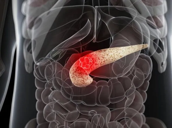 الإجهاد المزمن والسمنة يسرعان تطور سرطان البنكرياس