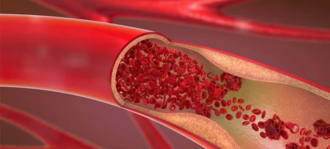 «تصلب الشرايين» يرتبط بالنظام الغذائي