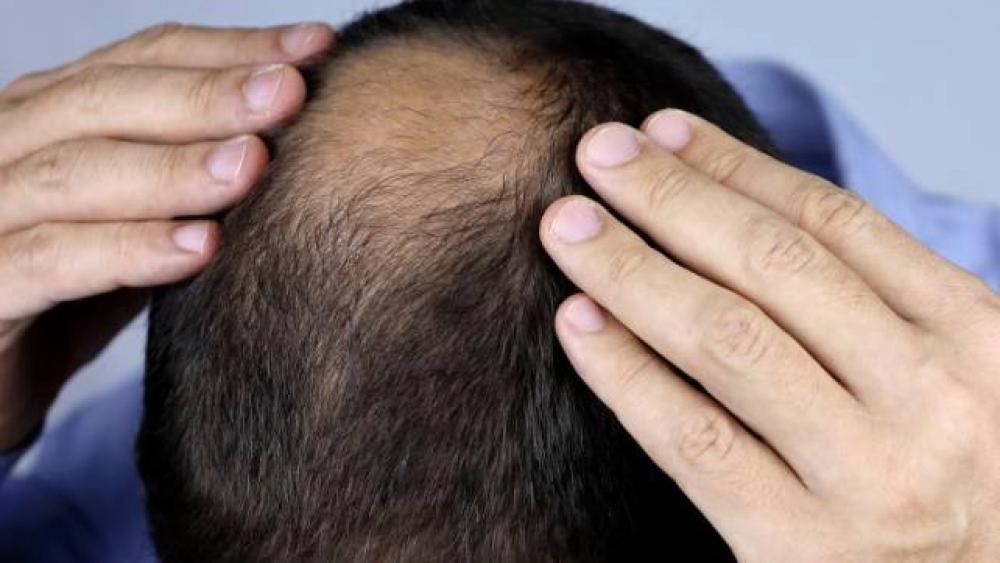 علاج جديد قد ينهي معاناة الصلع.. هل اقتربنا من نهاية تساقط الشعر؟