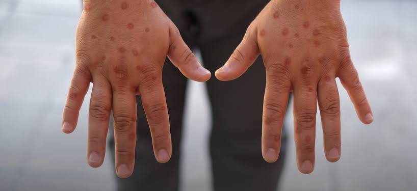 تقرير صادم.. جدري القردة يواصل انتشاره في 49 دولة والصحة العالمية تحذر