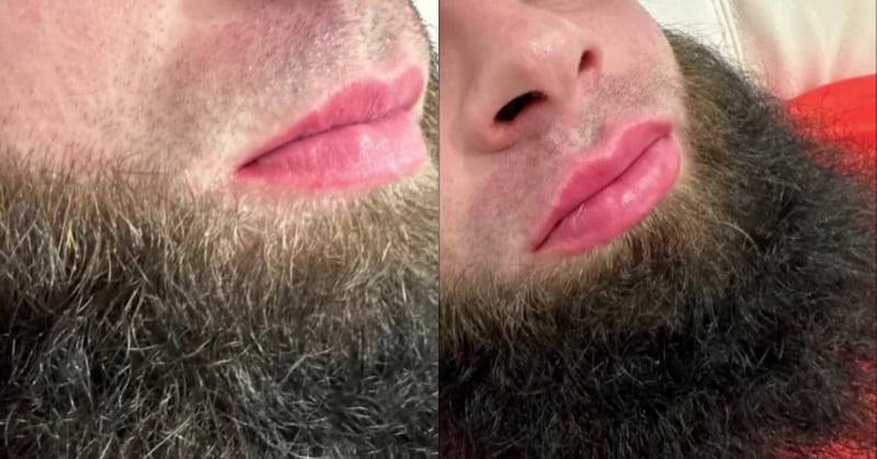 اتجاه تجميلي يثير الجدل.. إقبال رجال في داغستان على تكبير الشفاه