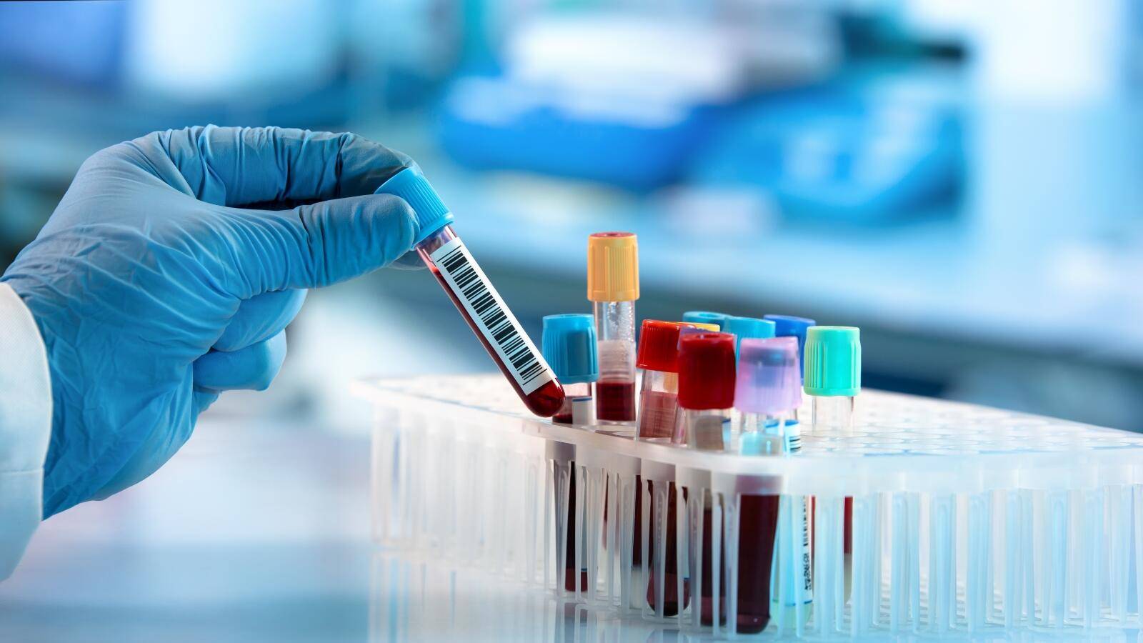 اختبار دم يتنبأ بتسمم الحمل قبل 5 أشهر