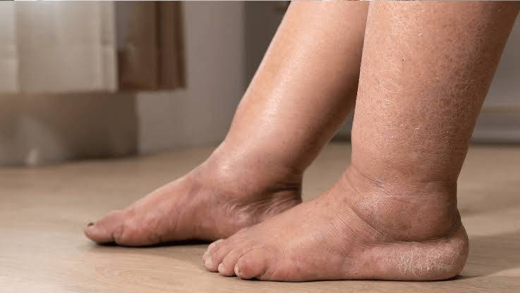 احتباس الماء في الجسم: متى يكون طبيعياً ومتى يصبح مؤشراً خطيراً ؟