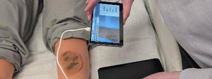 ابتكار طبي واعد.. تشخيص سرطان الجلد بالذكاء الاصطناعي في المناطق النائية