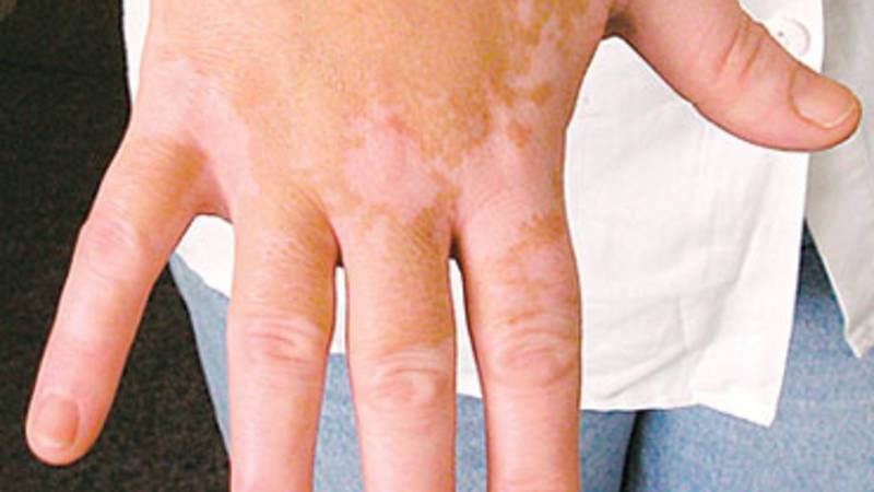 البهاق يزيد الإصابة بالاكتئاب 34%