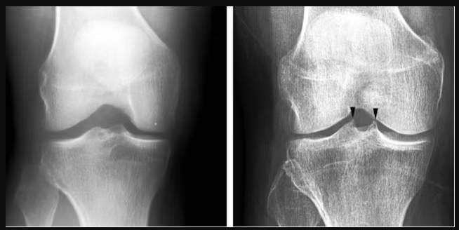 صورة أشعة لمصاب بالتهاب المفاصل التنكسي
