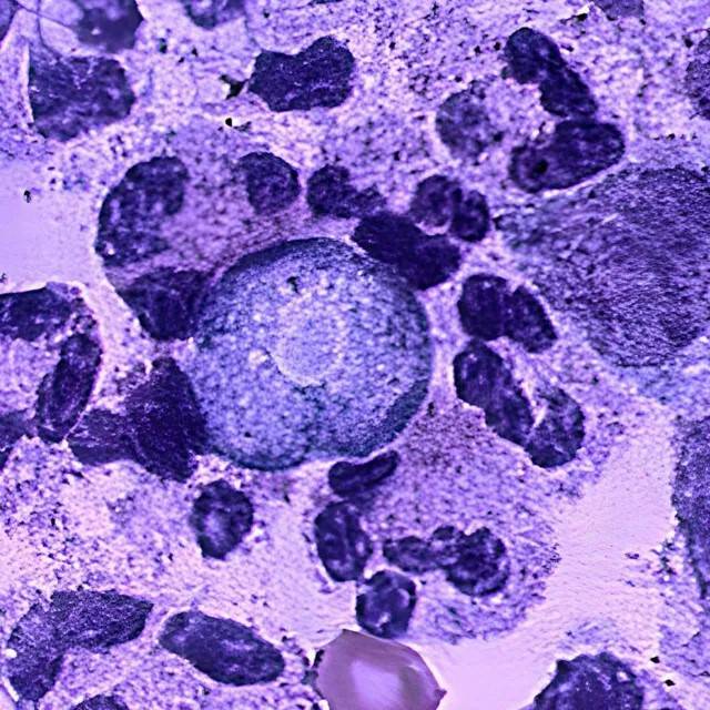 ارتفاع الإصابات بالأميبا آكلة الدماغ في كيرالا الهندية