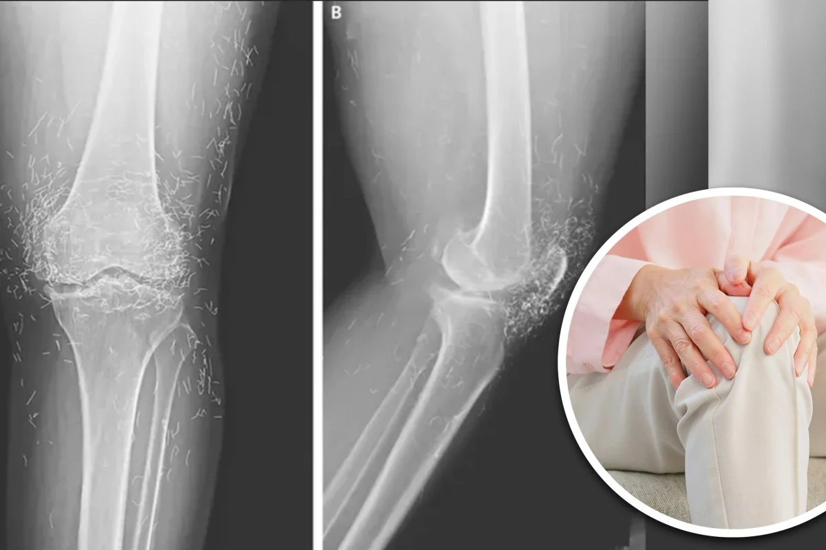 تحذيرات من علاج «الوخز بإبر خيوط الذهب»