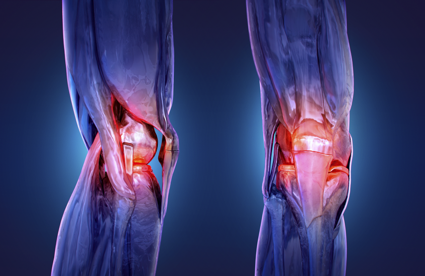 إشعاع يفتح آفاقاً لعلاج الالتهاب الروماتويدي بالركبة