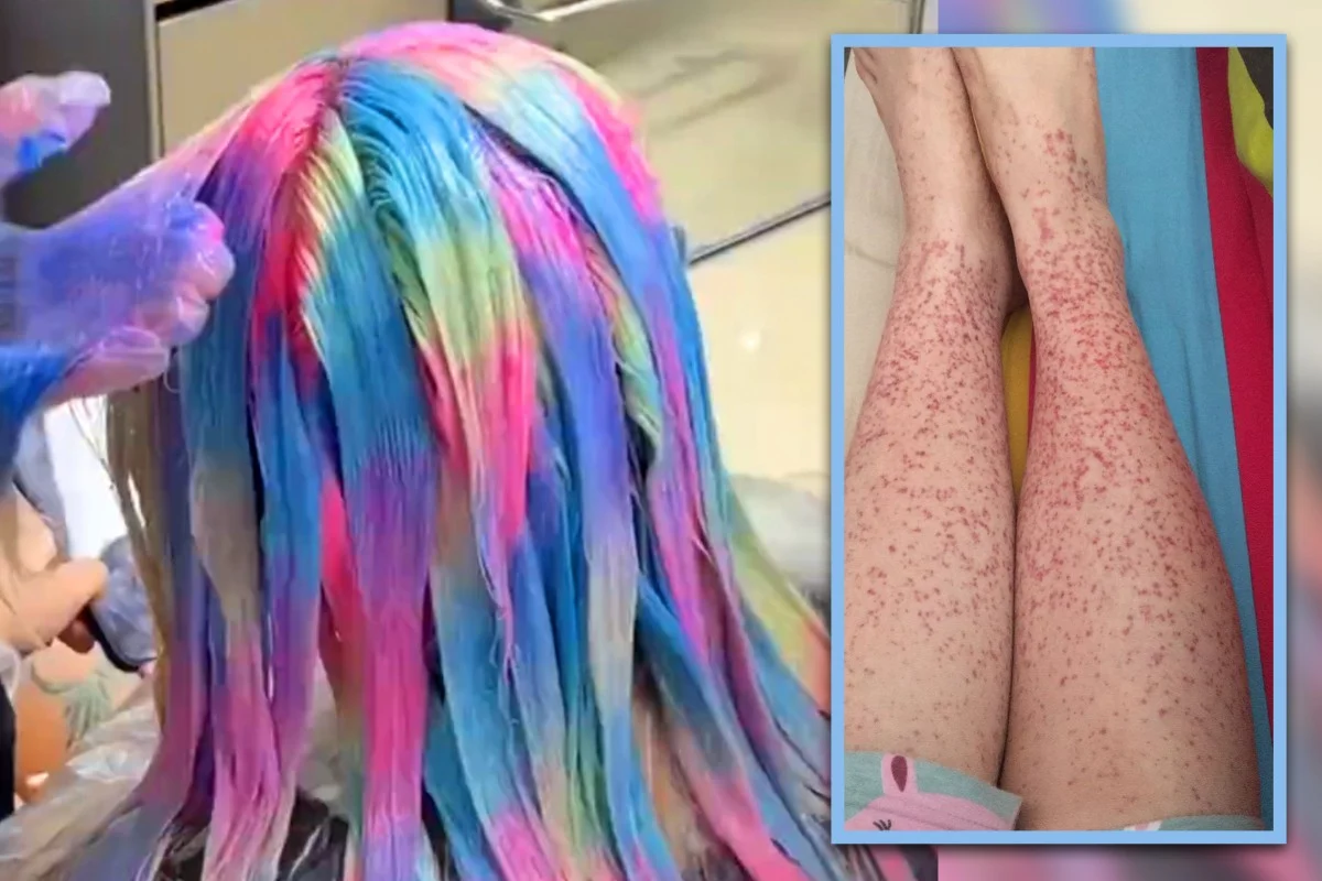 بقع حمراء منتشرة على ساقي هوا (يميناً) وأثناء صبغ شعرها 