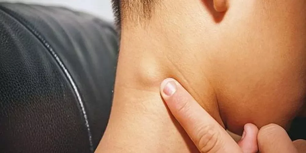 اكتشاف نوع جديد من سرطان الغدد الليمفاوية