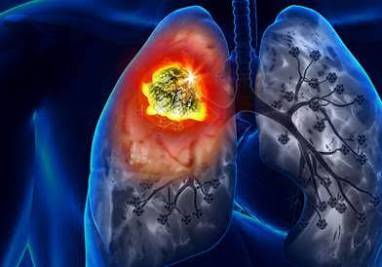 بدء تجربة أول لقاح لسرطان الرئة في 2026