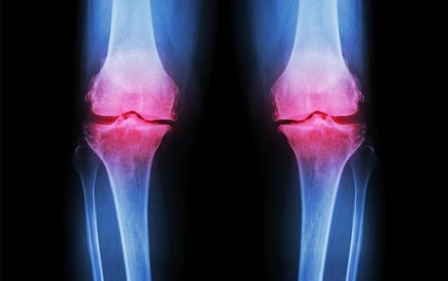 صورة أشعة لشخص يعاني التهاب المفاصل