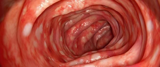 الالتهابات المعوية