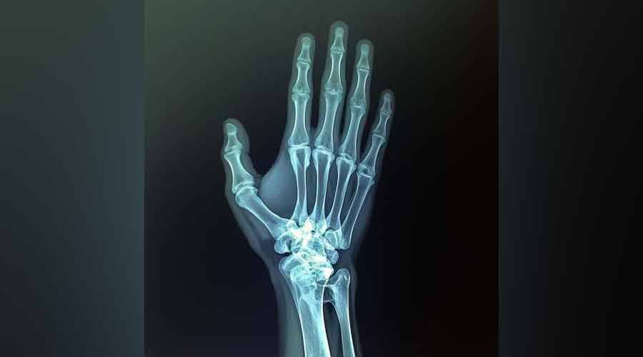 العلاج الهرموني «عبر الجلد» أكثر أماناً لعظام النساء