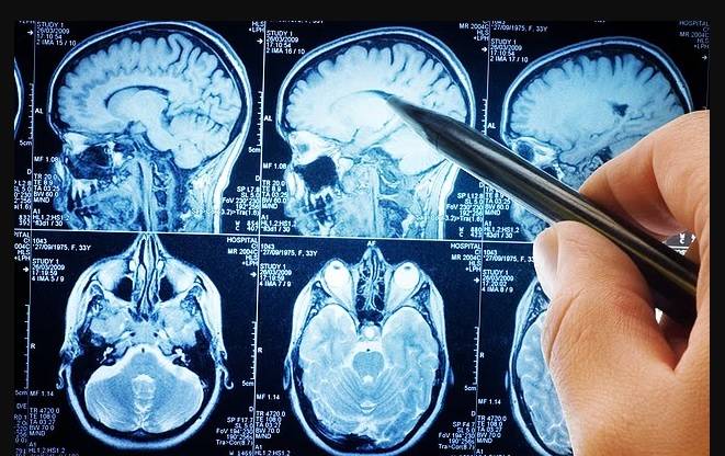 يحدث مرض باركنسون عن فقدان الخلايا العصبية المنتجة للدوبامين