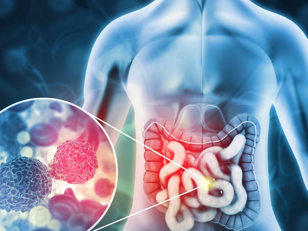 رسم حاسوبي لسرطان القولون 