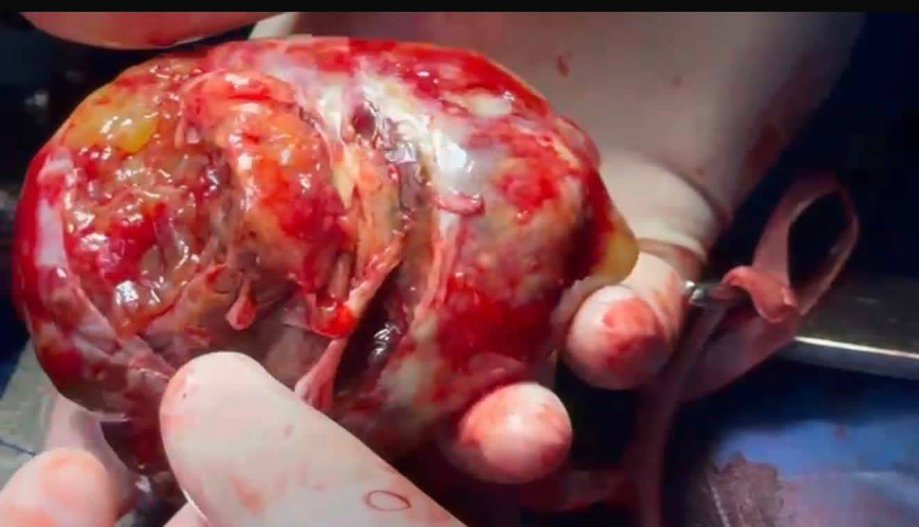 إنقاذ حياة مسن مصري باستئصال ورم من داخل القلب