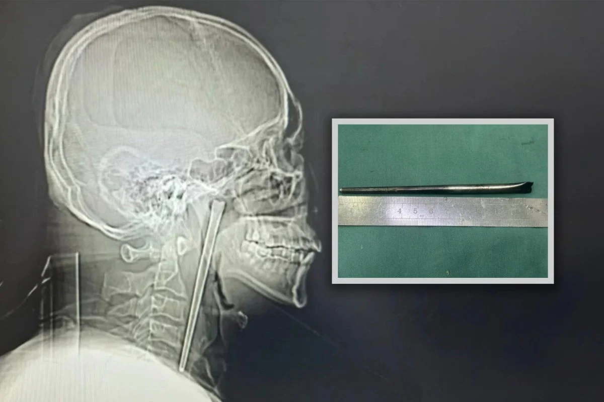 عود طعام 12 سم في حلق رجل لـ 8 سنوات