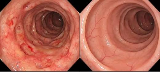 اكتشاف سبب عضوي للقولون العصبي