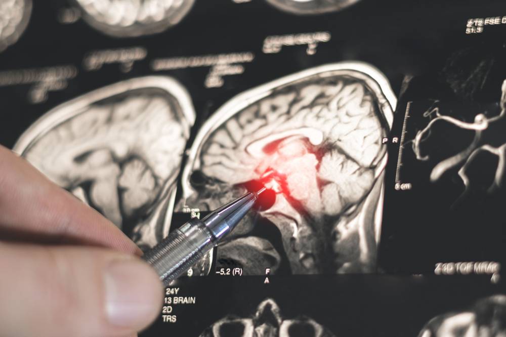 اكتشاف روسي جديد يفتح الطريق لتطوير أدوية لعلاج «باركنسون»