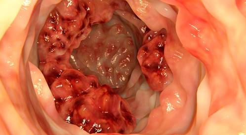 العلاج المناعي الكيميائي يقلص انتكاس سرطان القولون