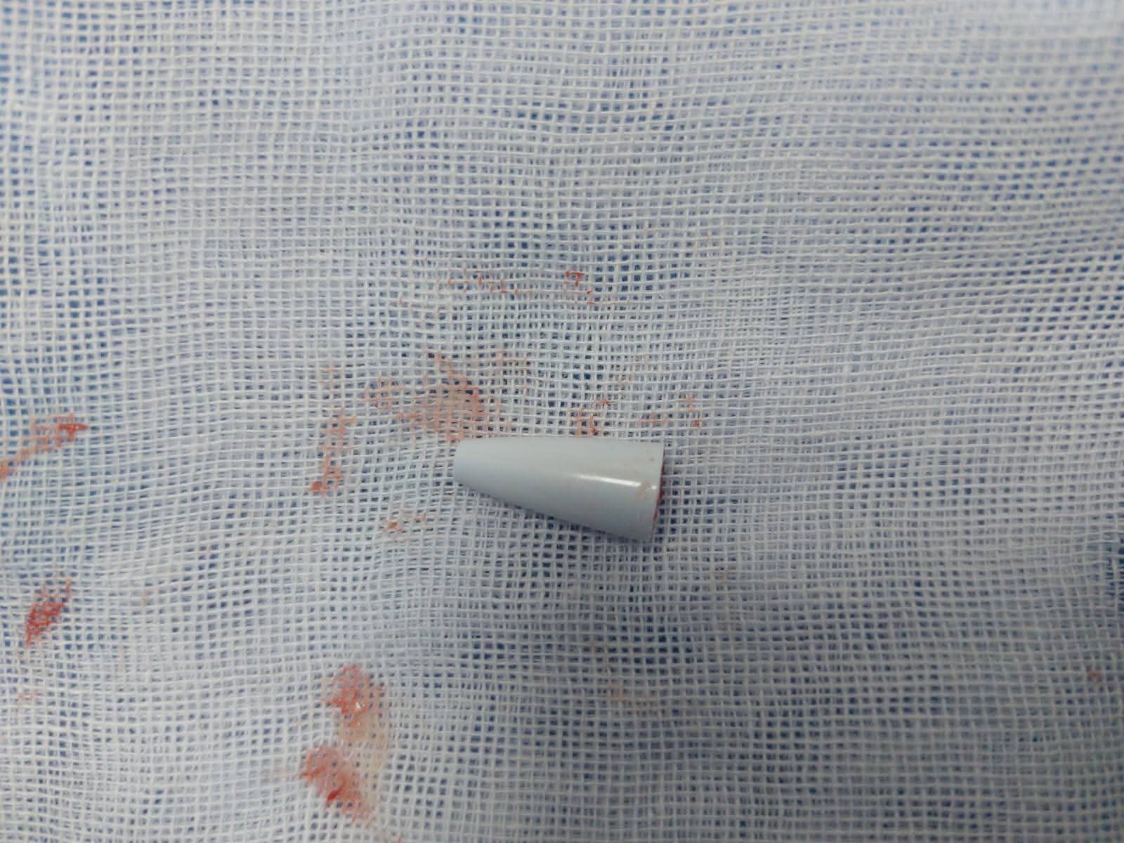 استخراج جسم غريب من الشعب الهوائية لطفل في مصر